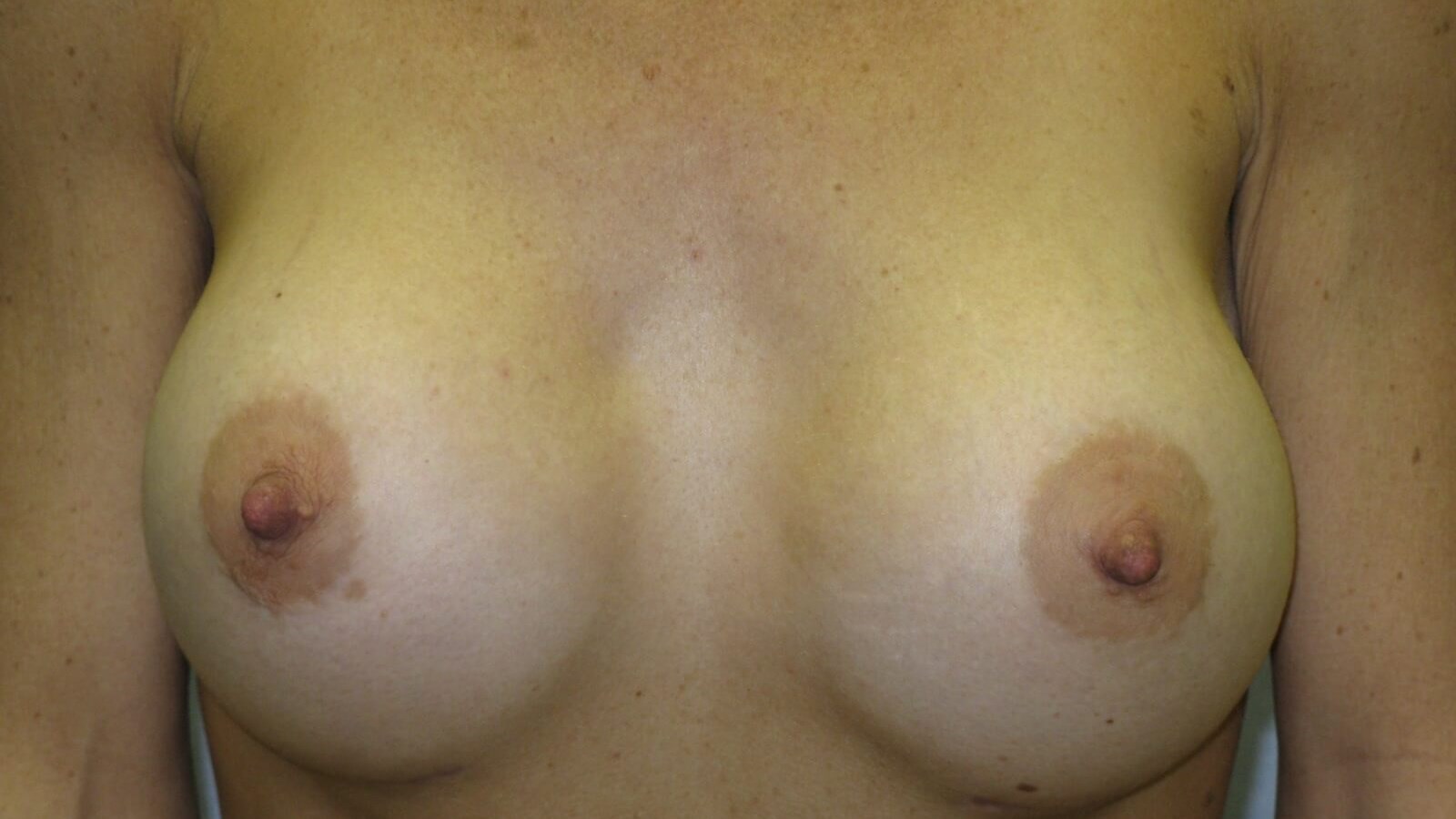 Post Op